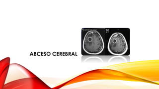 ABCESO CEREBRAL
 