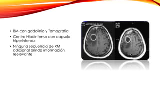 • RM con gadolinio y Tomografia
• Centro Hipointenso con capsula
hiperintensa
• Ninguna secuencia de RM
adicional brinda información
reelevante
 