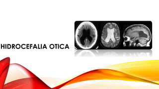HIDROCEFALIA OTICA
 