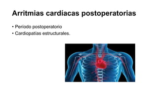 Arritmias cardíacas postoperatorias
• Período postoperatorio
• Cardiopatías estructurales.
 