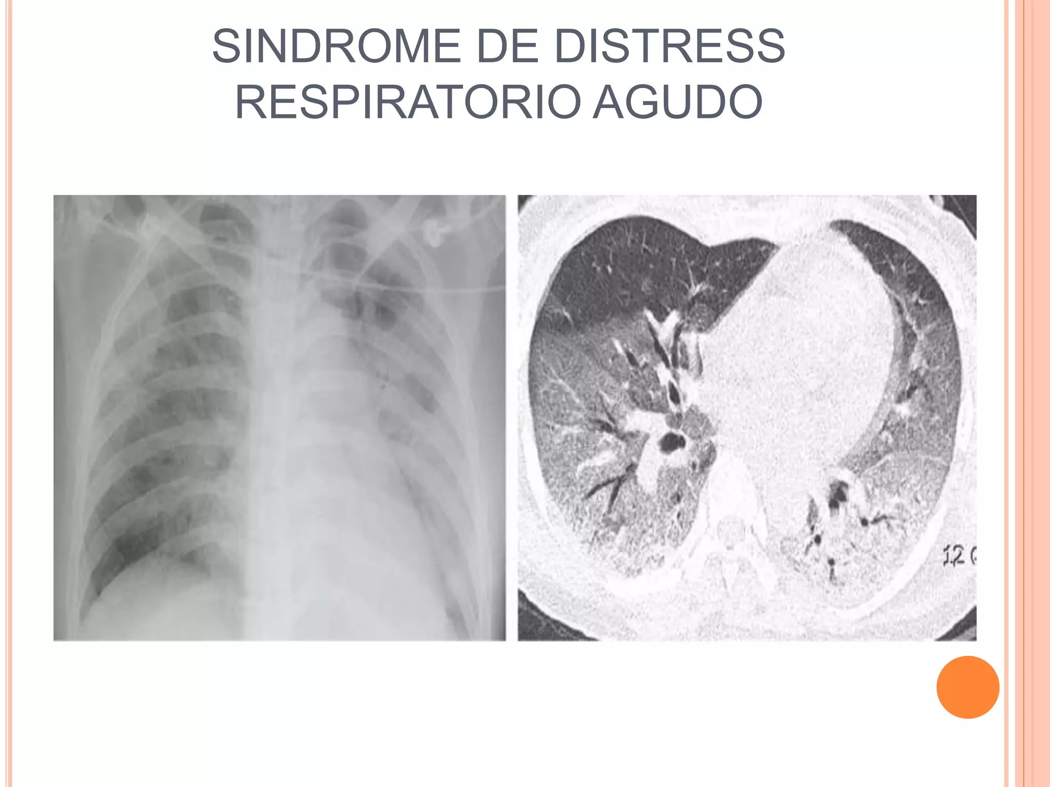 SINDROME DE DISTRESS
RESPIRATORIO AGUDO