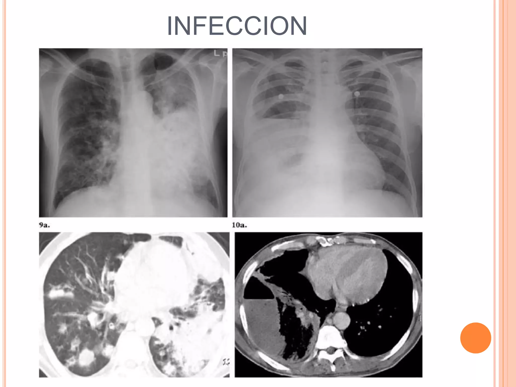 INFECCION