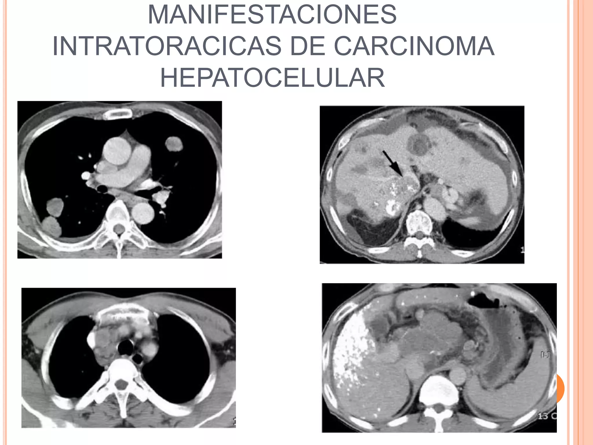MANIFESTACIONES
INTRATORACICAS DE CARCINOMA
HEPATOCELULAR