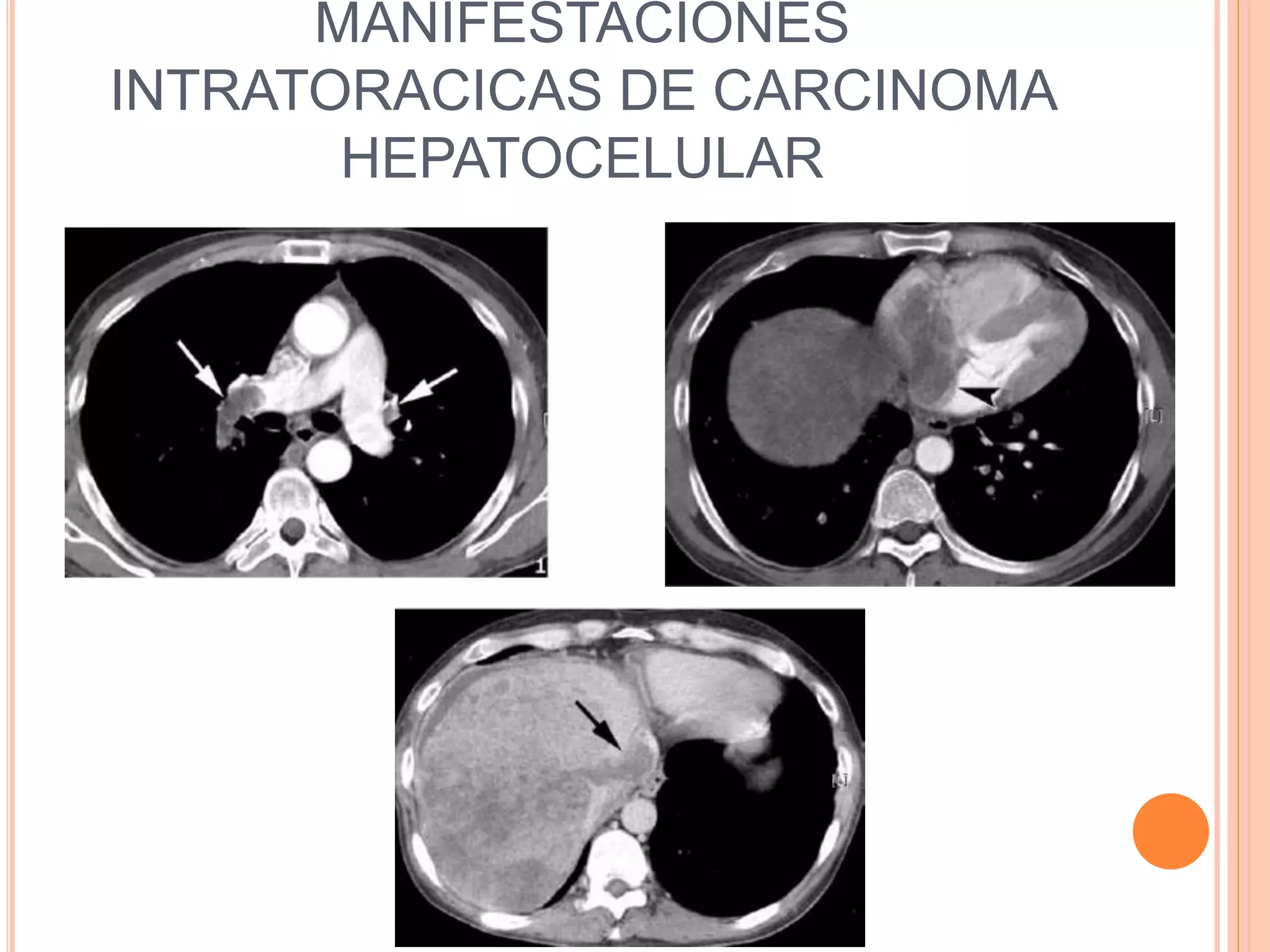 MANIFESTACIONES
INTRATORACICAS DE CARCINOMA
HEPATOCELULAR