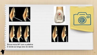 11
Broca inicia 90º com a palatina
E tende ao longo eixo do dente
 