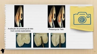 17
Avaliação da presença do teto
Com sonda exploratória
Presença do Teto
 