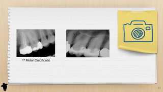 33
1º Molar Calcificado
 