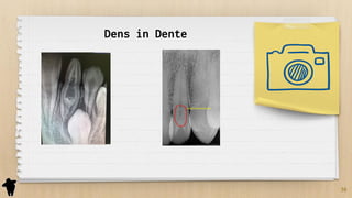 36
Dens in Dente
 