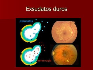 Exsudatos duros 