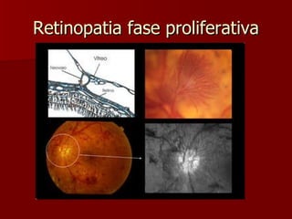 Retinopatia fase proliferativa 