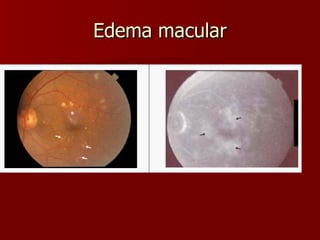 Edema macular 