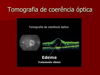 Tomografia de coerência óptica 