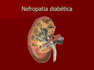 Nefropatia diabética 