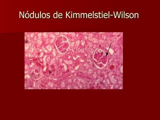 Nódulos de Kimmelstiel-Wilson 