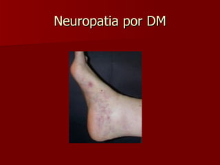 Neuropatia por DM 