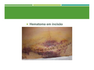  Hematoma em incisão
 