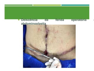  Deiscência da ferida operatória e
abdominoplastia
 