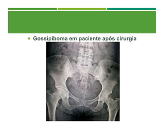  Gossipiboma em paciente após cirurgia
 