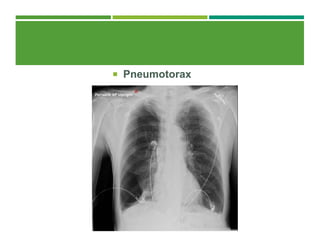 Pneumotorax
 