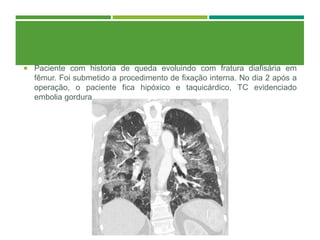  Paciente com historia de queda evoluindo com fratura diafisária em
fêmur. Foi submetido a procedimento de fixação interna. No dia 2 após a
operação, o paciente fica hipóxico e taquicárdico, TC evidenciado
embolia gordura.
 