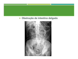  Obstrução de intestino delgado
 