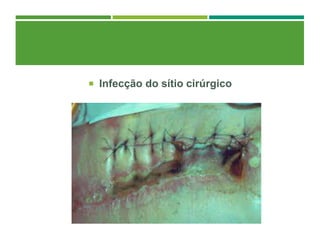  Infecção do sítio cirúrgico
 