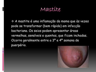  A mastite é uma inflamação da mama que às vezes
pode se transformar (bem rápido) em infecção
bacteriana. Os seios podem apresentar áreas
vermelhas, sensíveis e quentes, que ficam inchadas.
Ocorre geralmente entre a 3º e 4º semana de
puerpério.
 