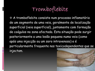  A tromboflebite consiste num processo inflamatório
de um segmento de uma veia, geralmente de localização
superficial (veia superficial), juntamente com formação
de coágulos na zona afectada. Esta situação pode surgir
posteriormente a uma lesão pequena numa veia (como
após uma injecção ou um soro intravenoso) e é
particularmente frequente nos toxicodependentes que se
injectam.
 