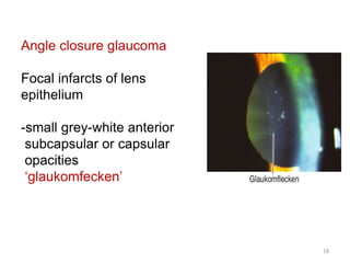 Angle closure glaucoma
Focal infarcts of lens
epithelium
-small grey-white anterior
subcapsular or capsular
opacities
‘glaukomfecken’
18
 