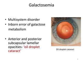 Galactosemia
• Multisystem disorder
• Inborn error of galactose
metabolism
• Anterior and posterior
subcapsular lamellar
opacities- ‘oil droplet
cataract’
Oil droplet cataract
8
 