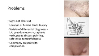 Problems
• Signs not clear-cut
• Location of fundus tends to vary
• Variety of differential diagnoses -
LN, pseudoaneurysm, saphena
varix, psoas abscess pointing,
soft tissue tumour/abscess
• Commonly present with
complication
 
