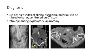Diagnosis
• Pre-op: high index of clinical suspicion, notorious to be
missed on x-ray, confirmed on CT scan
• Intra-op: during exploratory laparotomy
 