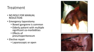 Treatment
• NO ROLE FOR MANUAL
REDUCTION
• Emergency laparotomy
• Bowel gangrene is common
• Elderly patient with multiple
significant co-morbidities
• Effects of
pneumoperitoneum
• Elective repair
• Laparoscopic or open
 