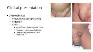 Clinical presentation
• Uncomplicated
• Impulse on coughing/straining
• Reducible
• Extent
• Bubonocele - within inguinal canal
• Funicular - exited superficial ring
• Complete inguinoscrotal - into
scrotal sac
 