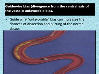 • Guide wire “unfavorable” bias can increases the
chances of dissection and burring of the normal
tissue.
 