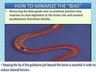 HOW TO MINIMIZE THE “BIAS”
• Retracting the Rota guide wire to proximal position may
improve co axial alignment at the lesion site and prevent
psudolesions formation distally .
 