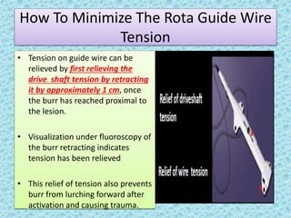 How To Minimize The Rota Guide Wire
Tension
• Tension on guide wire can be
relieved by first relieving the
drive shaft tension by retracting
it by approximately 1 cm, once
the burr has reached proximal to
the lesion.
• Visualization under fluoroscopy of
the burr retracting indicates
tension has been relieved
• This relief of tension also prevents
burr from lurching forward after
activation and causing trauma.
 