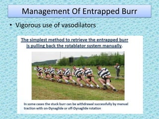 Management Of Entrapped Burr
• Vigorous use of vasodilators
 