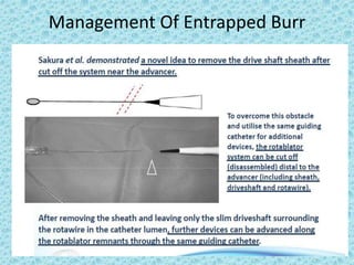 Management Of Entrapped Burr
 