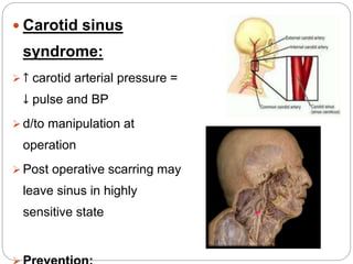  Carotid sinus
syndrome:
 ↑ carotid arterial pressure =
↓ pulse and BP
 d/to manipulation at
operation
 Post operative...