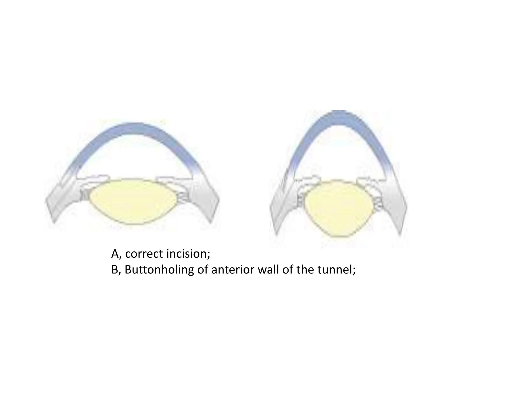 A, correct incision;
B, Buttonholing of anterior wall of the tunnel;
 