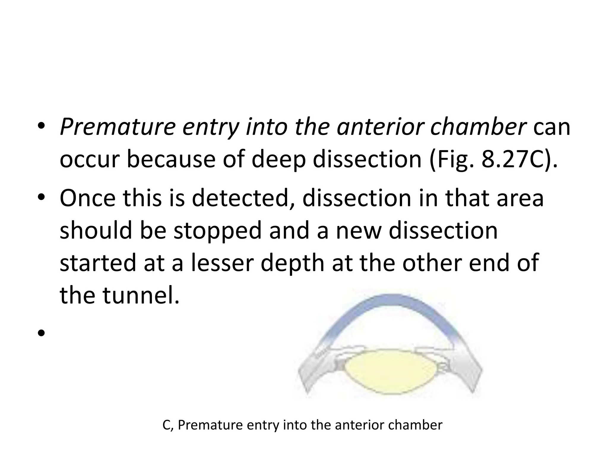 • Premature entry into the anterior chamber can
occur because of deep dissection (Fig. 8.27C).
• Once this is detected, dissection in that area
should be stopped and a new dissection
started at a lesser depth at the other end of
the tunnel.
•
C, Premature entry into the anterior chamber
 