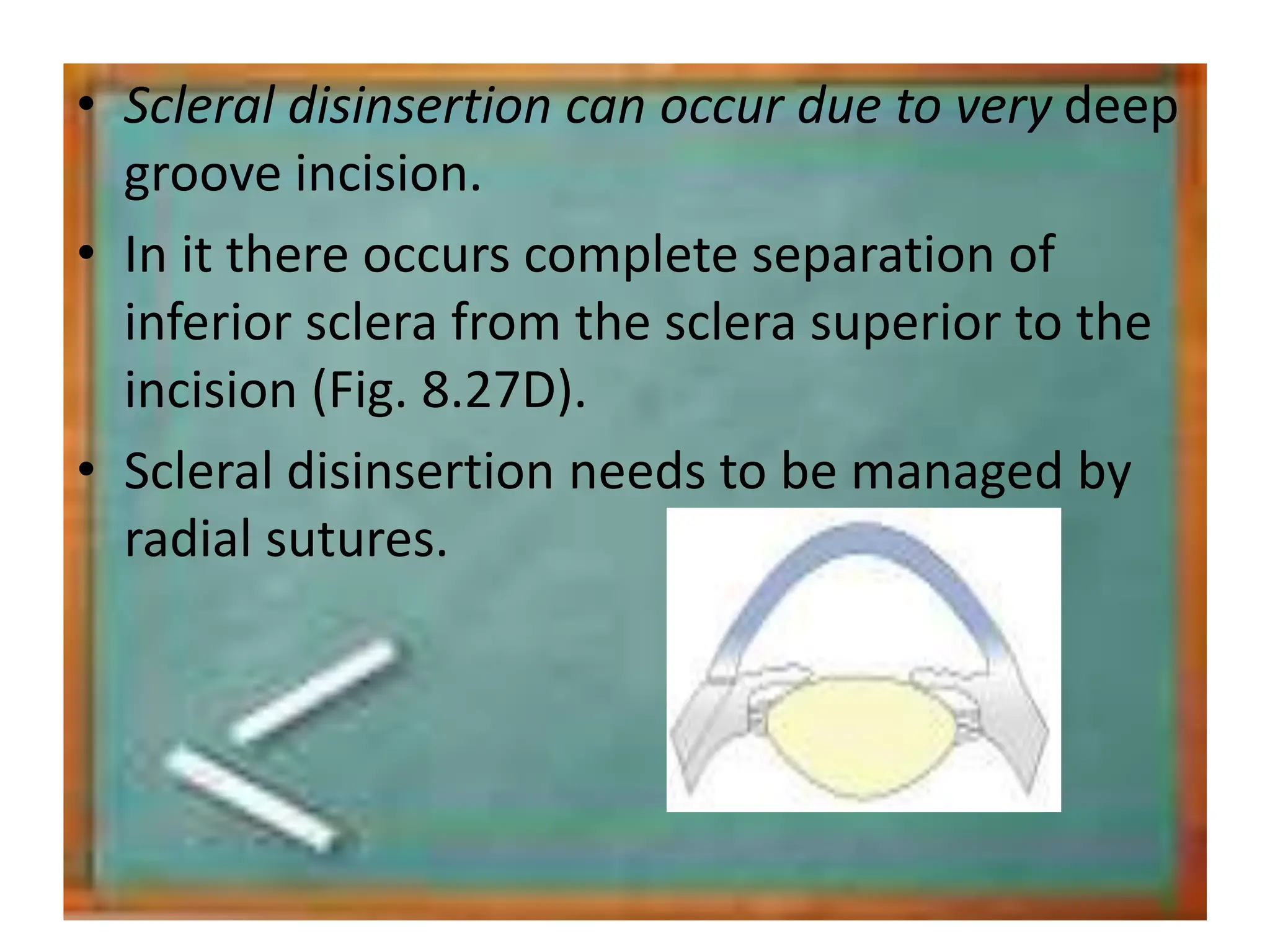 • Scleral disinsertion can occur due to very deep
groove incision.
• In it there occurs complete separation of
inferior sclera from the sclera superior to the
incision (Fig. 8.27D).
• Scleral disinsertion needs to be managed by
radial sutures.
 