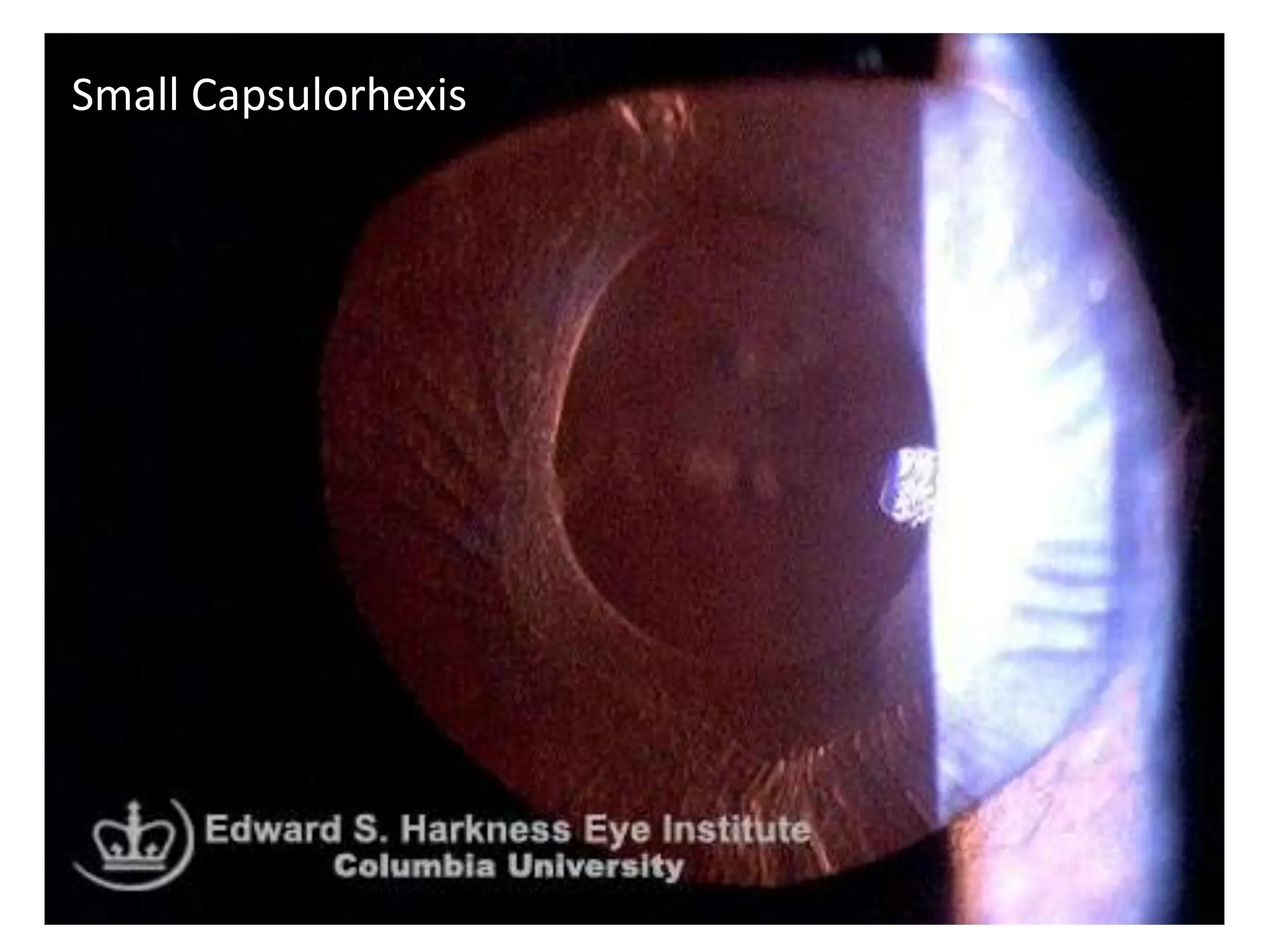 Small Capsulorhexis
 