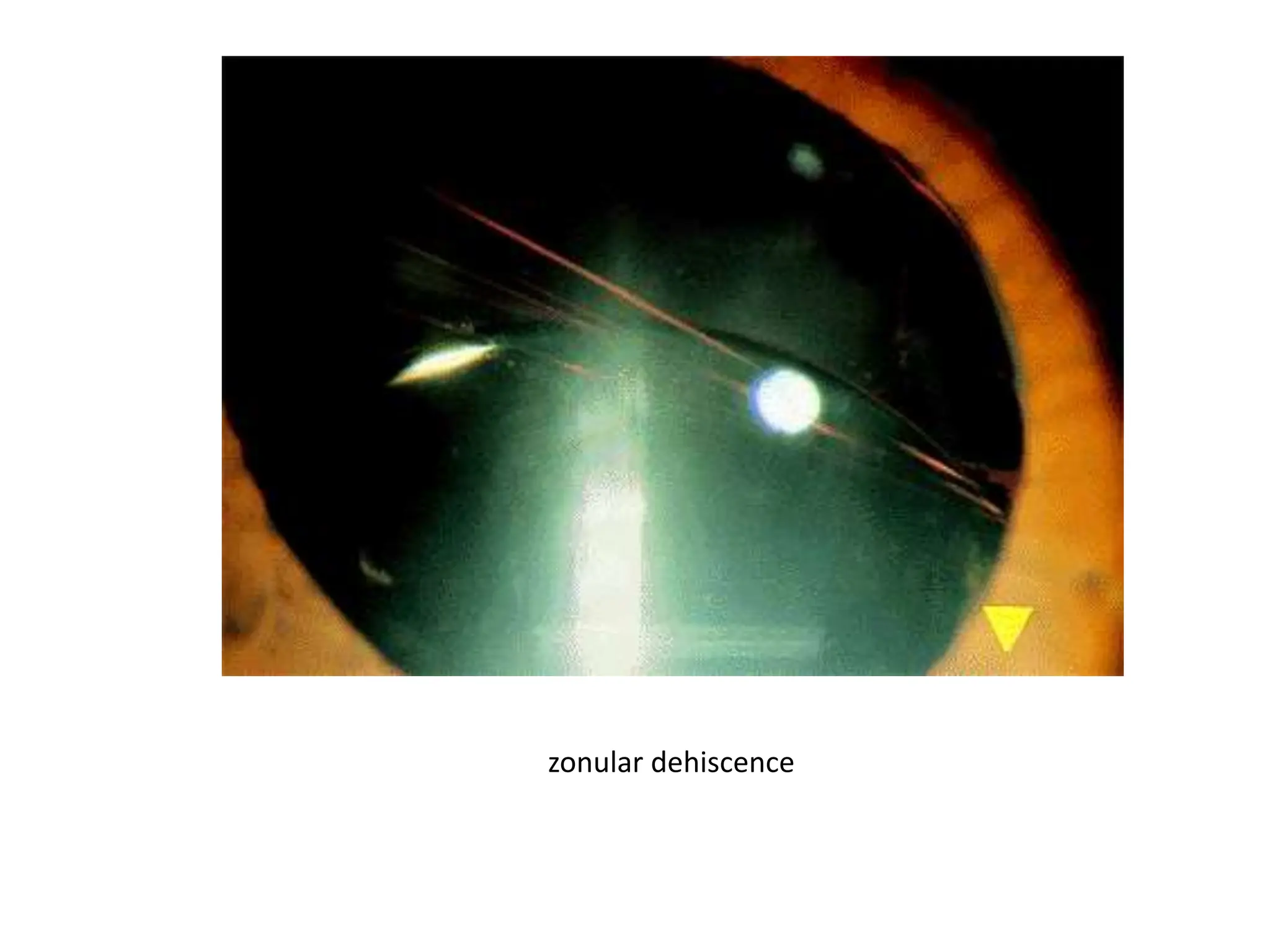 zonular dehiscence
 