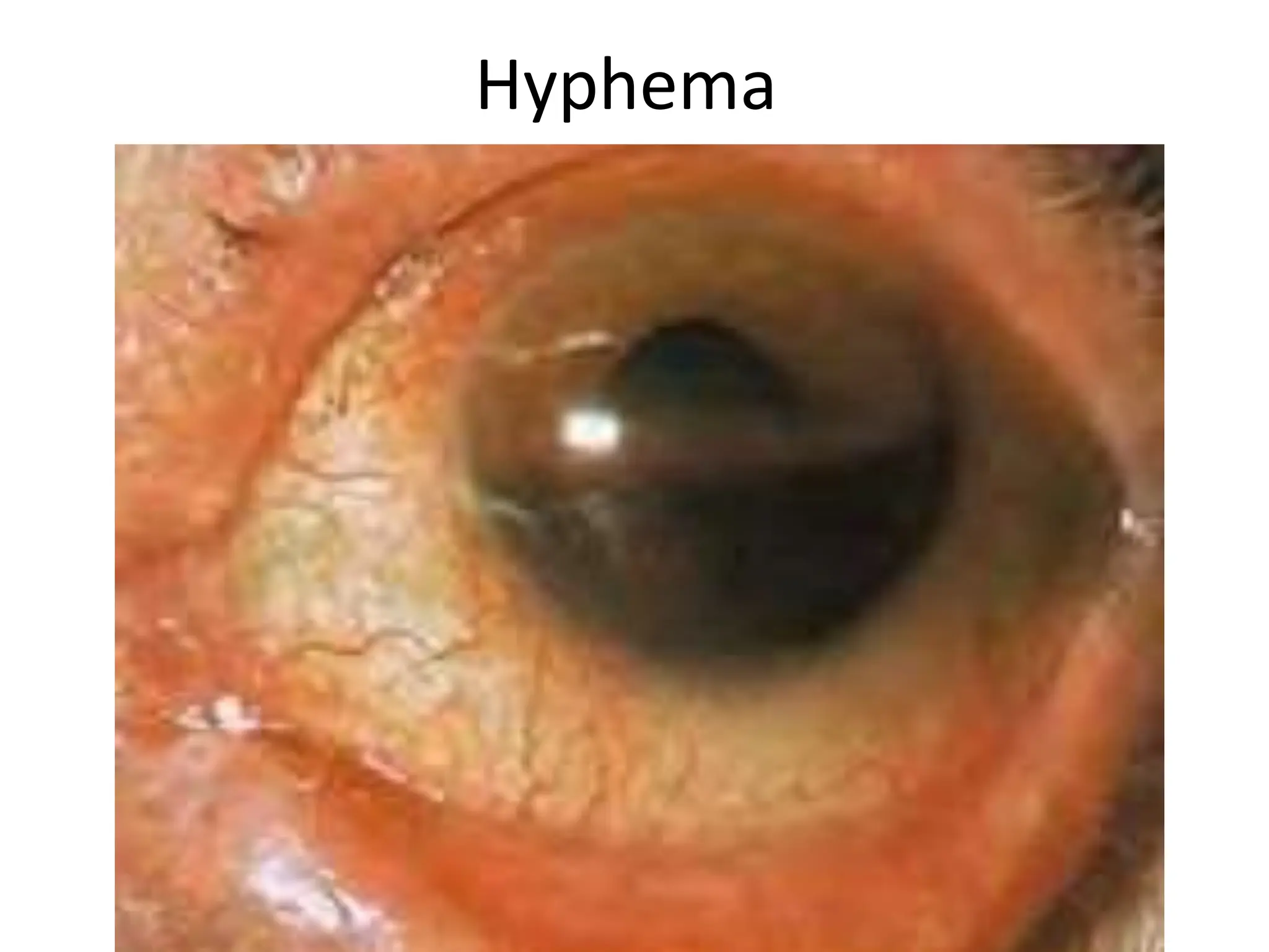 Hyphema
 