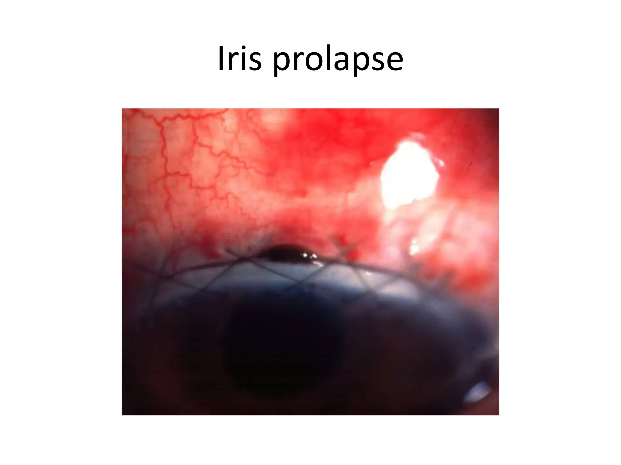Iris prolapse
 