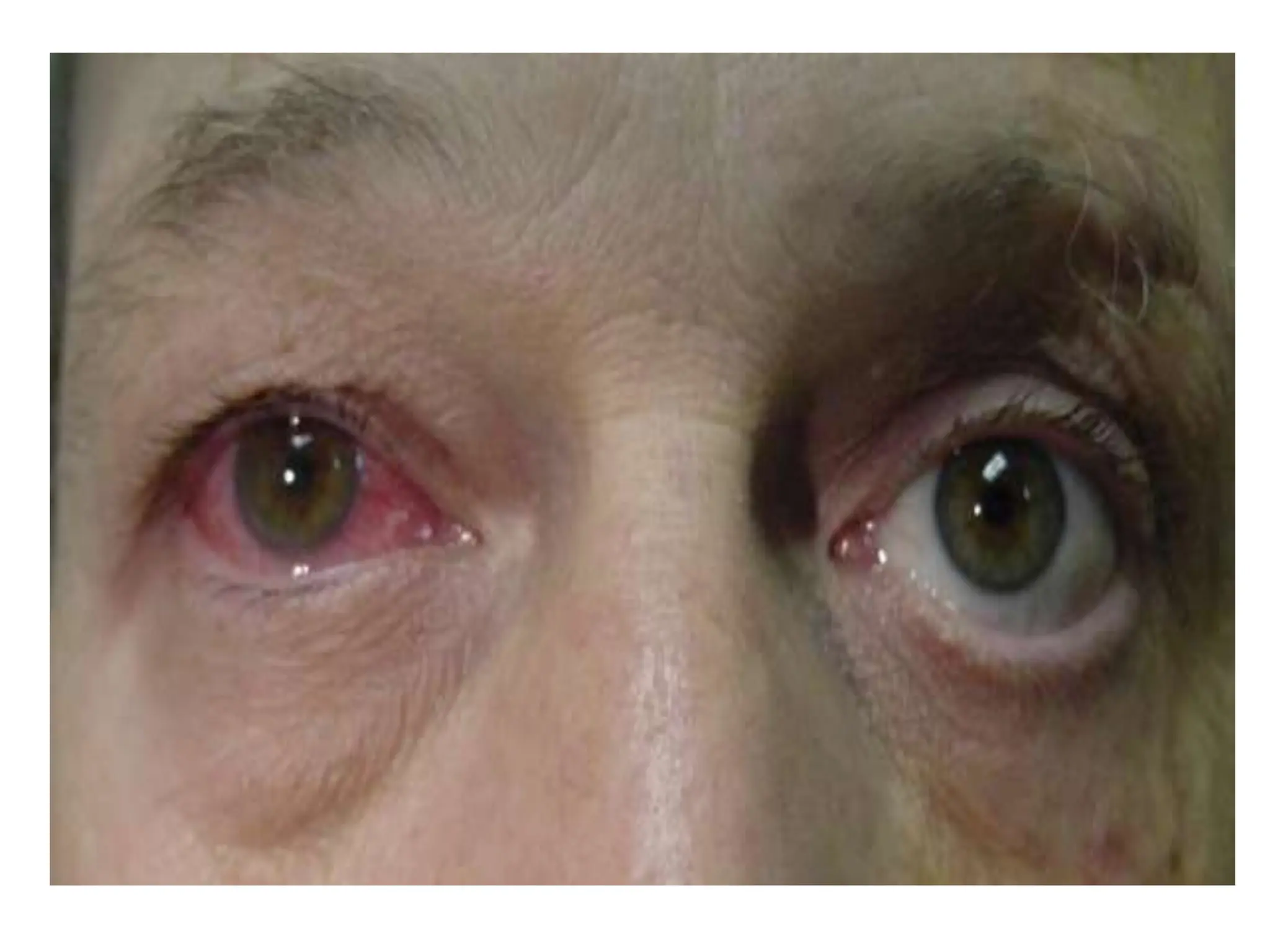 • (5) Postoperative anterior uveitis can be
induced by instrumental trauma, undue
handling of uveal tissue, reaction to residual
cortex or chemical reaction induced by
viscoelastics, pilocarpine etc.
• Management includes more aggressive use of
topical steroids, cycloplegics.
 