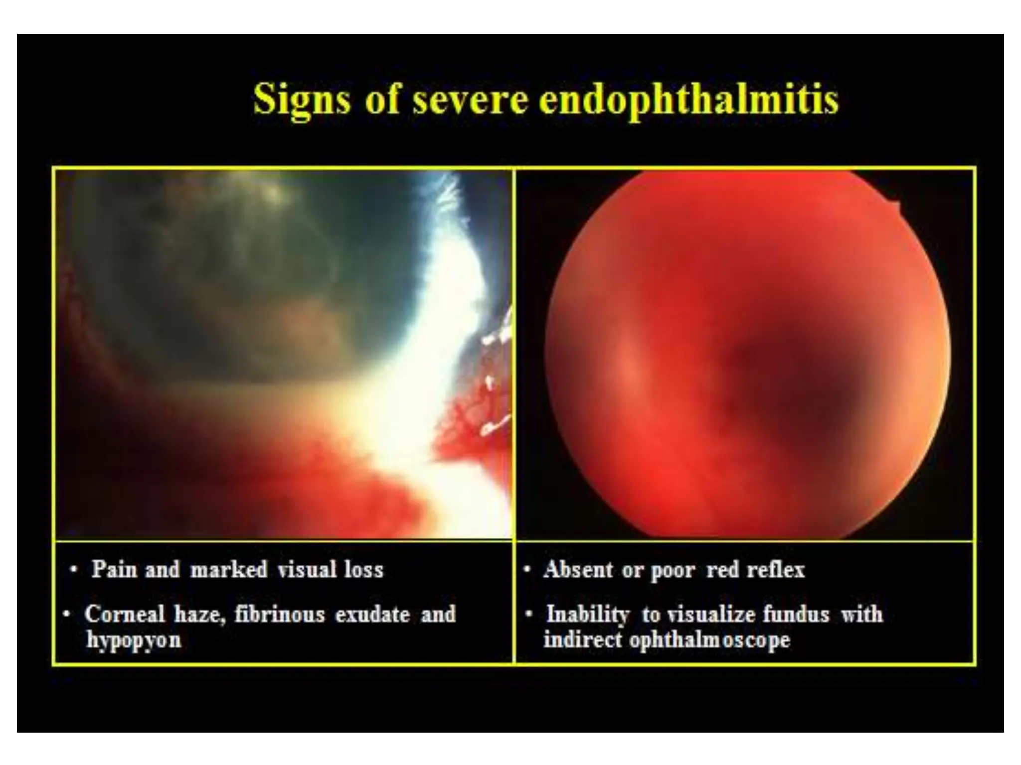 • Bacterial endophthalmitis- dreadful
complication with an incidence 0.2 to 0.5%.
- Sorce of infection- contaminated solution,
instruments, surgeon’s hands, pt’s own flora
from conjunctiva, eyelids, & air-borne
bacteria.
- Sign & symptom : ocular pain , diminished of
vision , corneal oedema
 