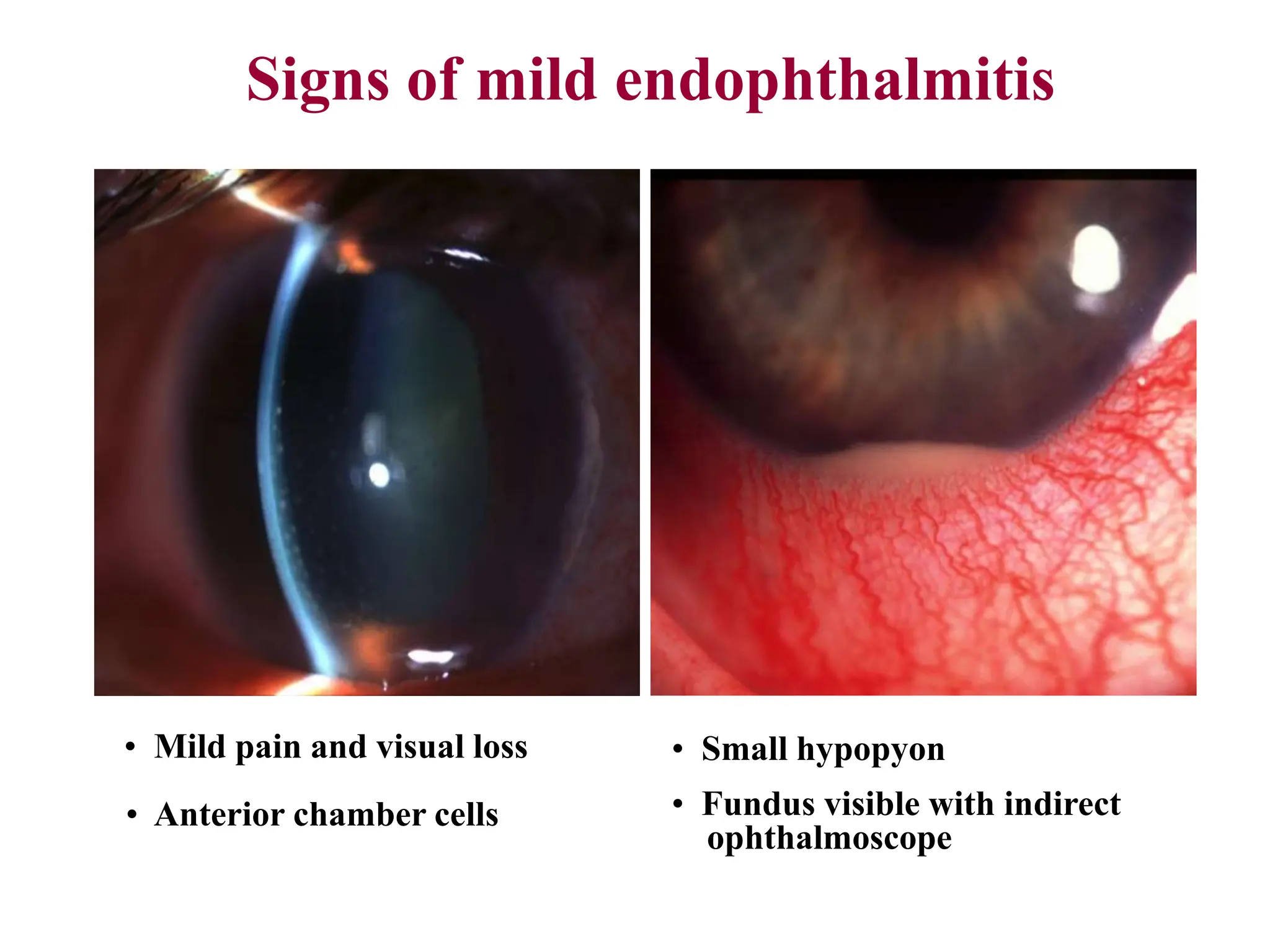 Signs of mild endophthalmitis
• Mild pain and visual loss
• Anterior chamber cells
• Small hypopyon
• Fundus visible with indirect
ophthalmoscope
 